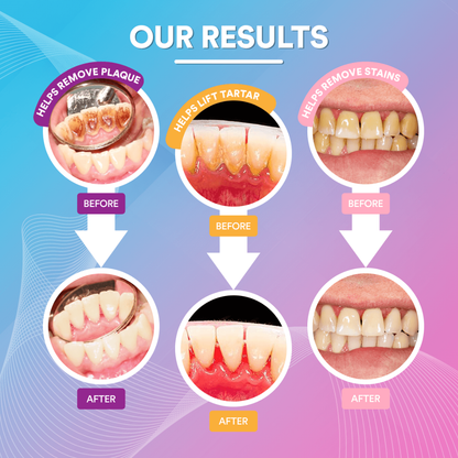 Remove Years of Stubborn Plaque & Stains at Home in Just Minutes, Without a Single Dentist Appointment!